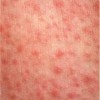Up-tick in Measles Cases